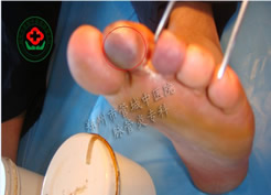病例血栓闭塞性脉管炎患者王某