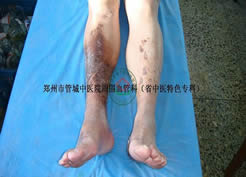 我脉管炎科一名长春静脉炎患者康复出院！