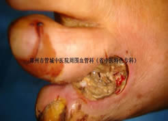 动脉硬化闭塞症患者溃烂面痊愈病例
