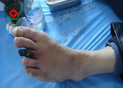血栓闭塞性脉管炎病例 侯某