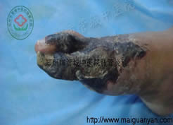 血栓闭塞性脉管炎患者唐某，男，35岁，