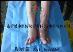 《走进科学》视频_脉管炎专业医院