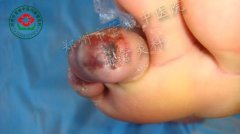 王某，男，28岁，血栓闭塞性脉管炎