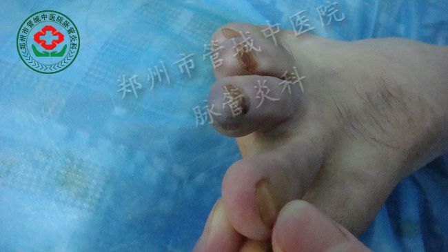 脉管炎康复
