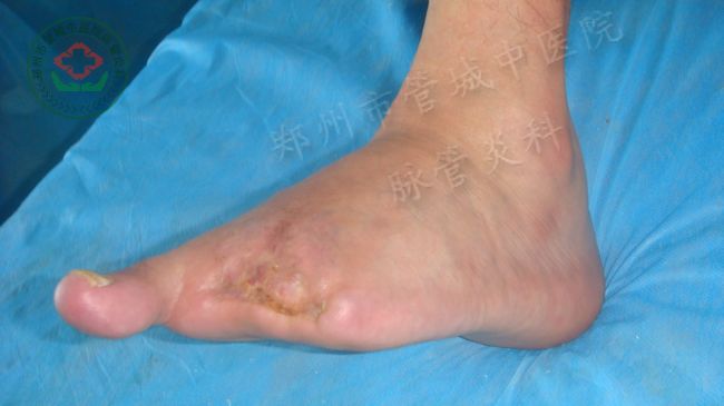 愈合照片2
