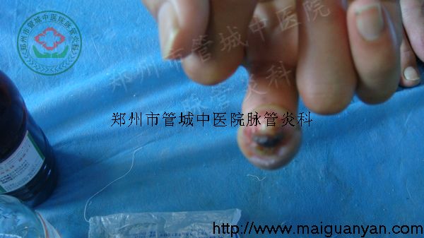 脉管炎的症状3