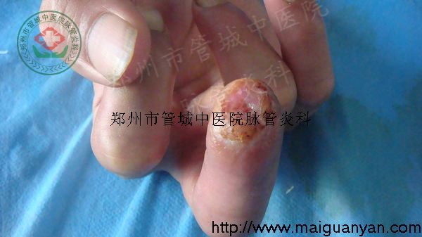 脉管炎的治疗